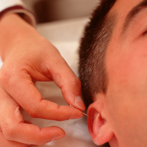 Auriculoterapia - aplicação